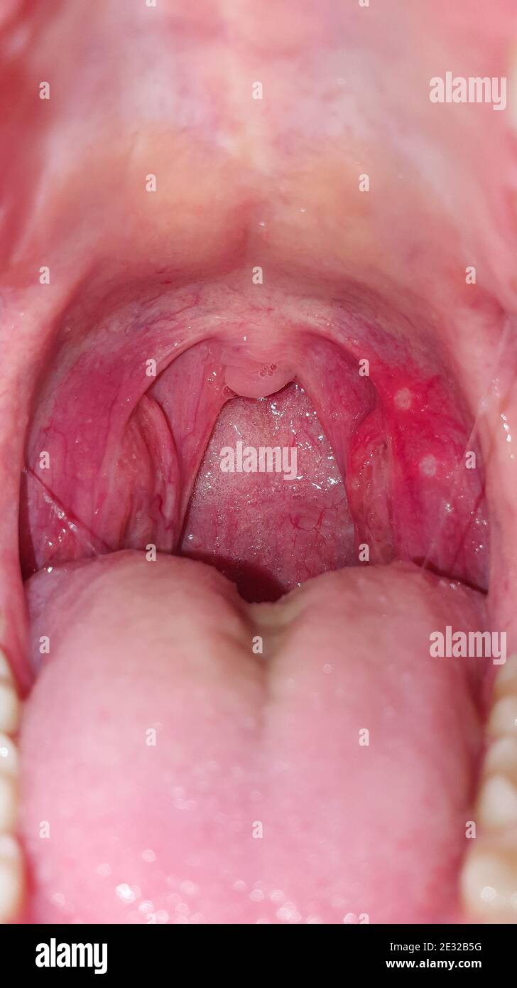 Sore throat inside the mouth, closeup. Diseases of the throat and mucous membrane, redness of the throat and tonsils, the phenomenon of stomatitis and Stock Photo