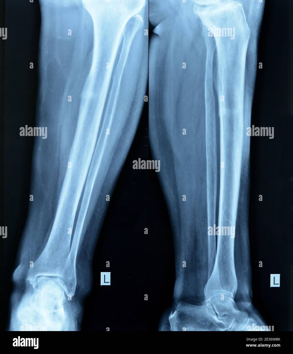 Tibia metal plate hi-res stock photography and images - Alamy