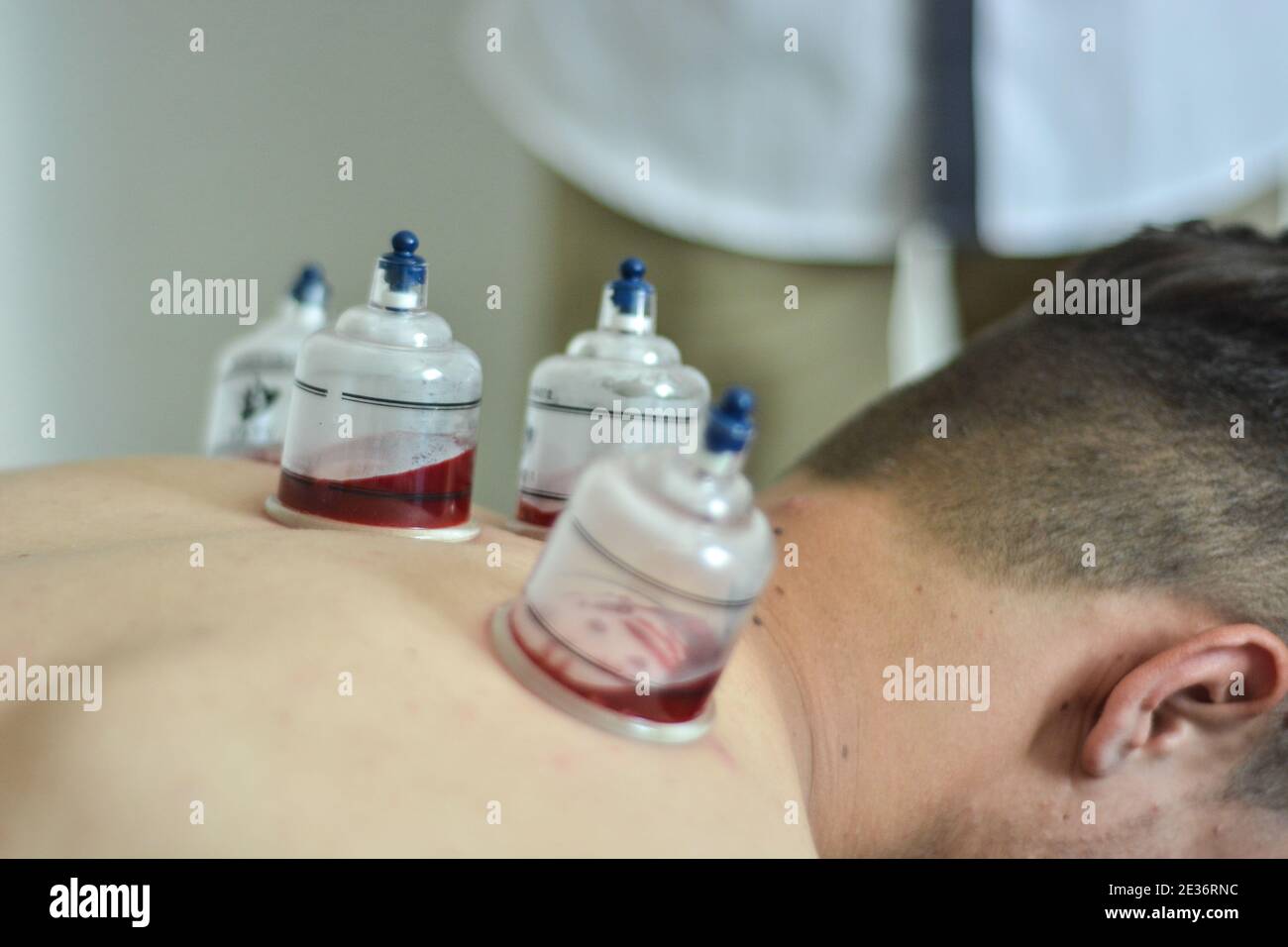 A closeup of a young man prepared for the hijama treatment Stock Photo