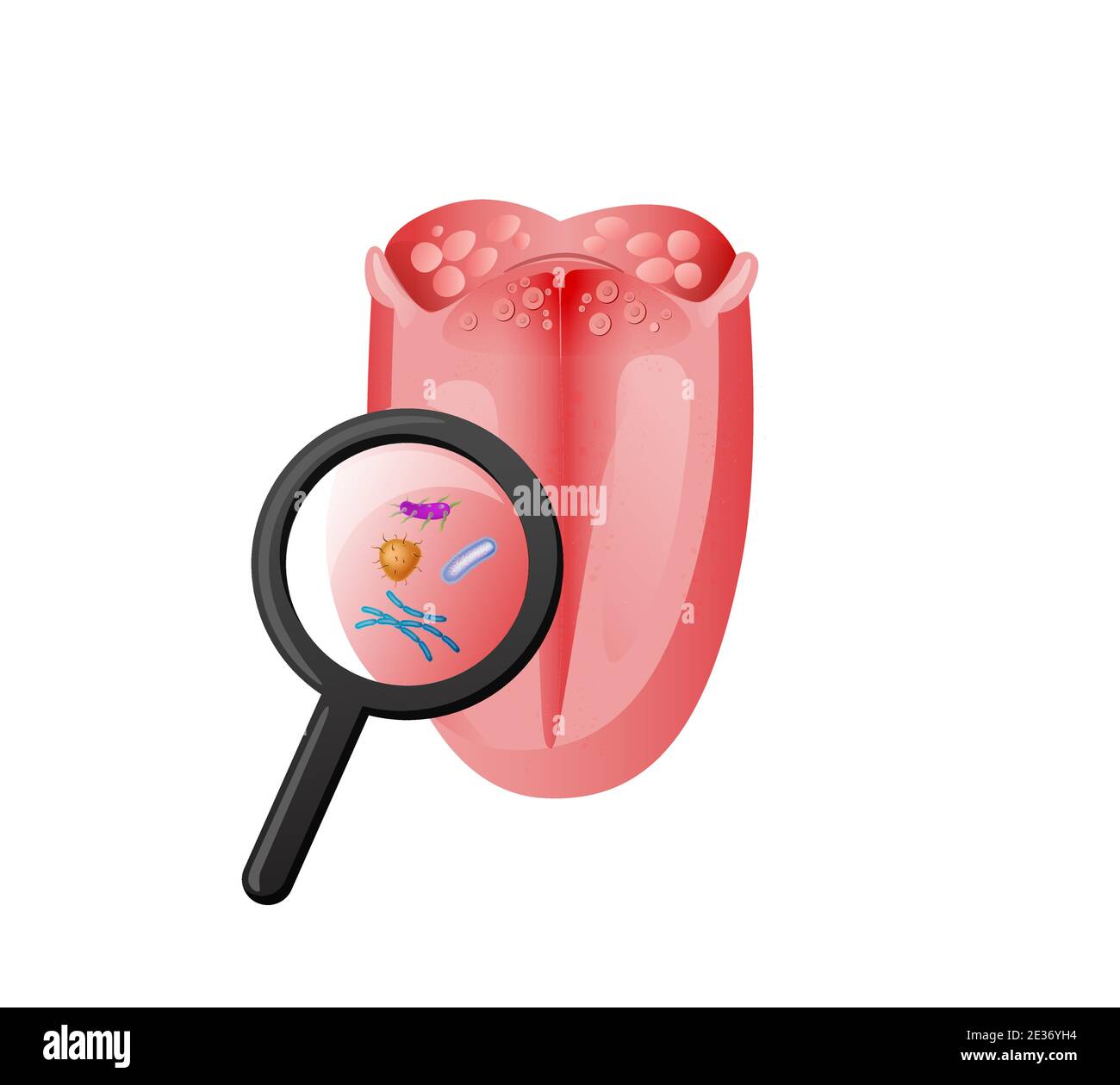 Tongue examination infection and bacteria illustration. Magnifying glass study inflammation red tissue and taste disturbances. Stock Vector
