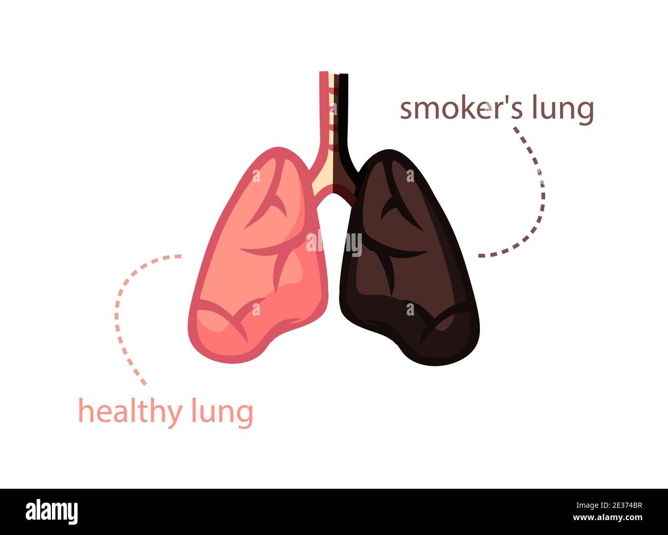 Lungs smoker and healthy person. Wholesome pink organ and blackened from tobacco. Stock Vector