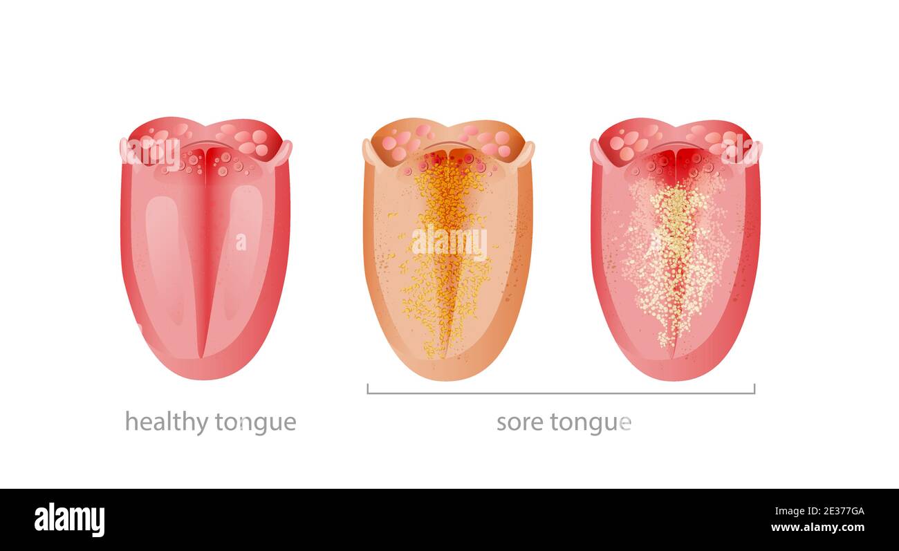 Healthy and sick tongue. Pink pure organ and affected yellow infectious plaque and fungus bacterial. Stock Vector