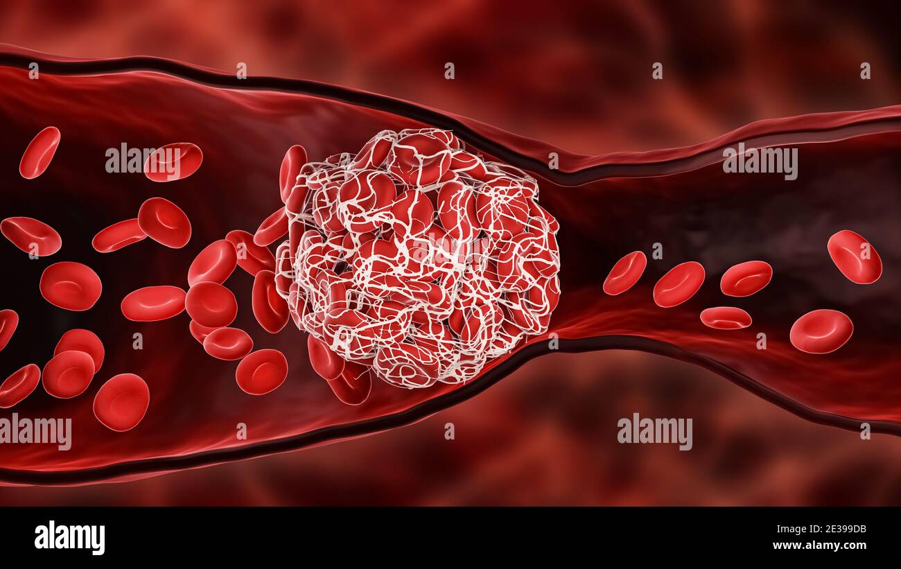 Blood Clot or thrombus blocking the red blood cells stream within an artery or a vein 3D rendering illustration. Thrombosis, cardiovascular system, me Stock Photo