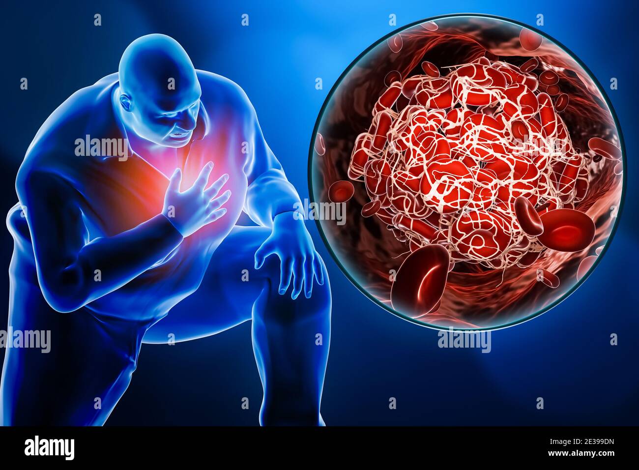Obese or overweight man suffering a heart attack or a pulmonary embolism with a close-up image of a blood clot 3D rendering illustration. Medicine, me Stock Photo