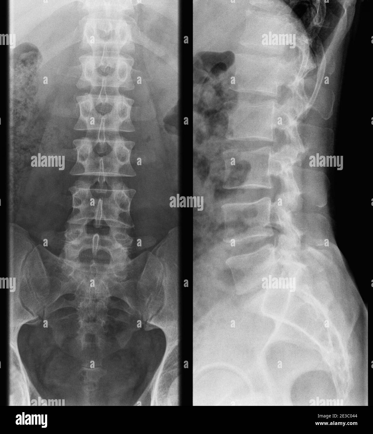 x-ray photo of human lumbar spine - adult man, front and side view Stock Photo