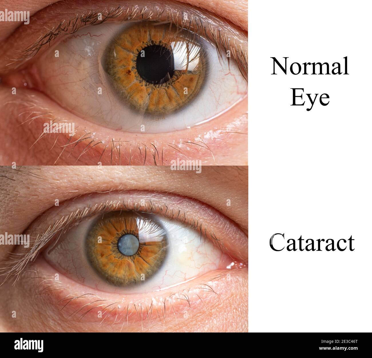 Comparison of a healthy human eye and an eye with a clouded lens cataract Stock Photo