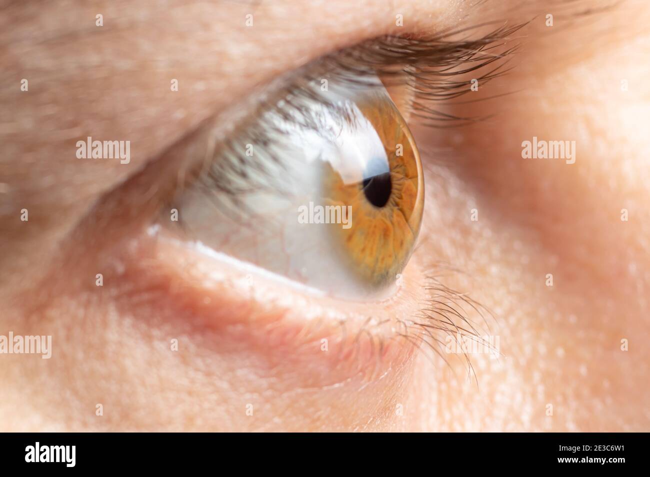 A man with glaucoma bulged his eyes. Increased intraocular pressure, eye disease Stock Photo