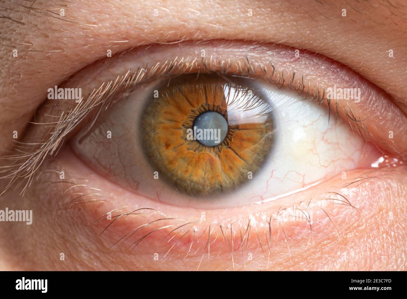 Macro photos of the human eye - cataract clouding of the lens, deterioration of vision. Cataract treatment, surgery and ophthalmology Stock Photo