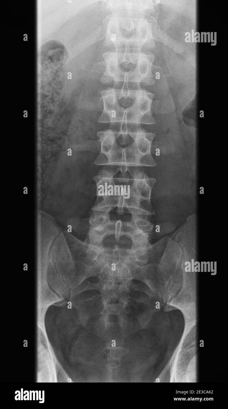 x-ray photo of human lumbar spine - adult man, front view Stock Photo