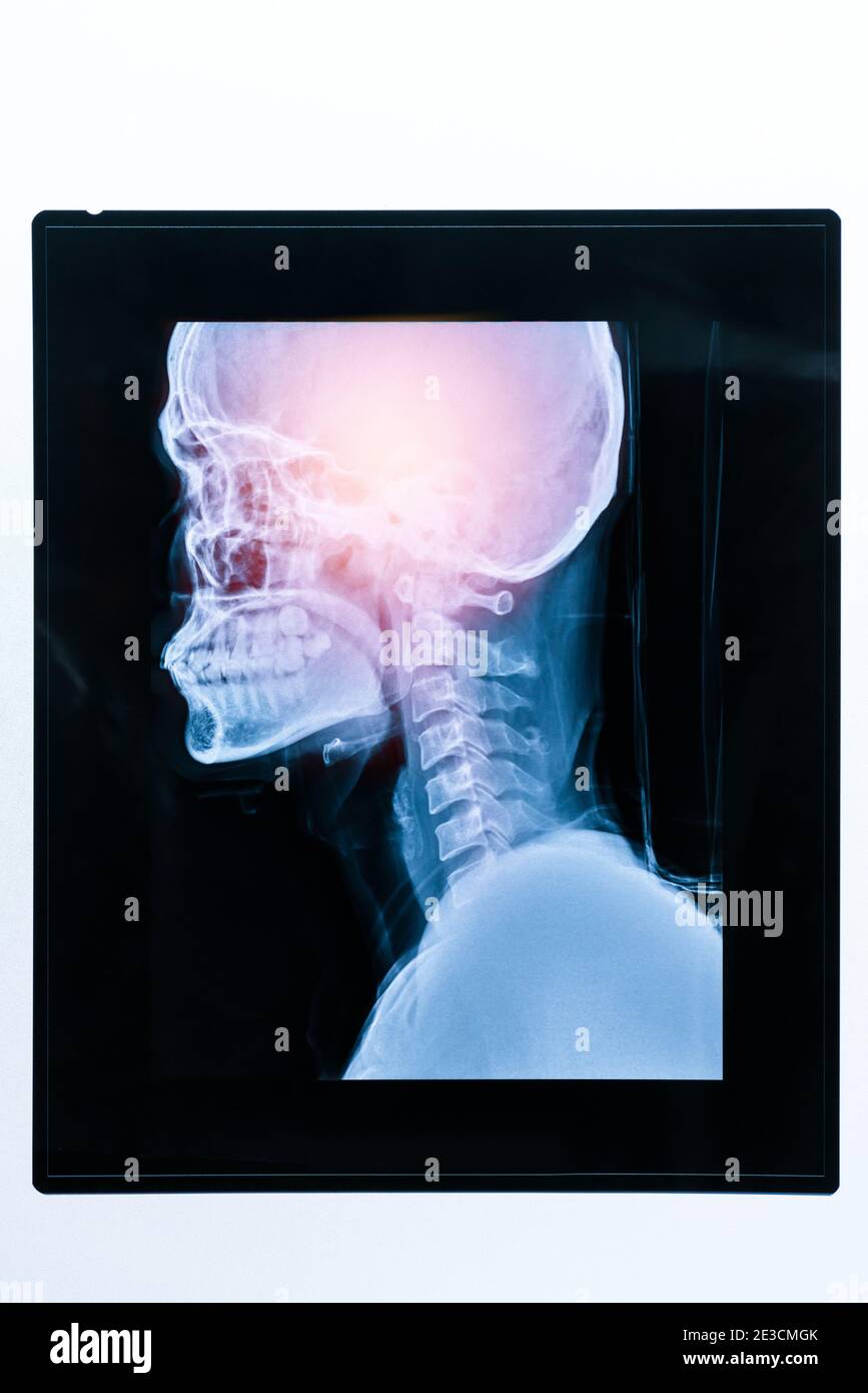 Medical X ray image of patient head and skull. Healthcare concept Stock