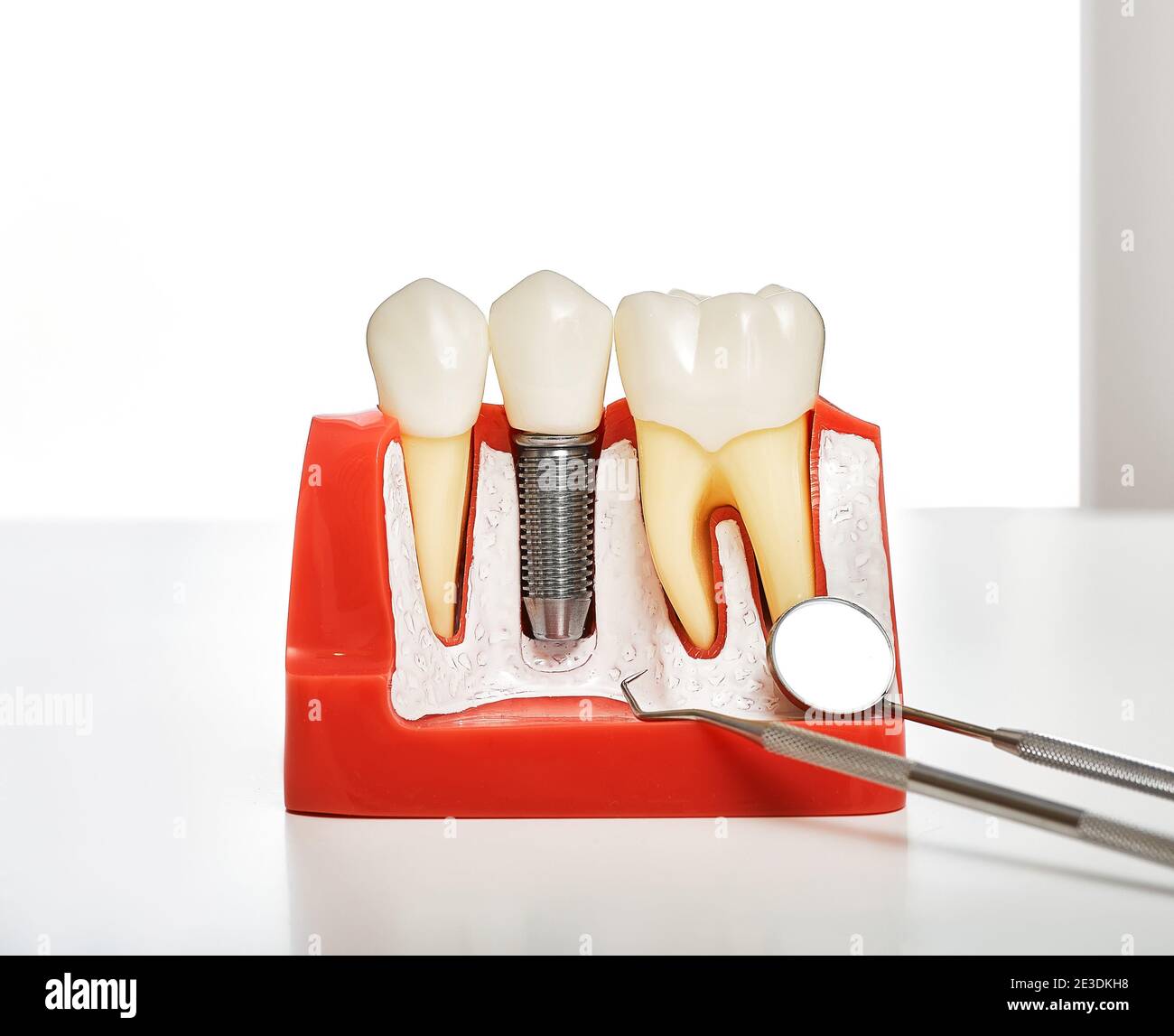 Dental prosthetics hires stock photography and images Alamy