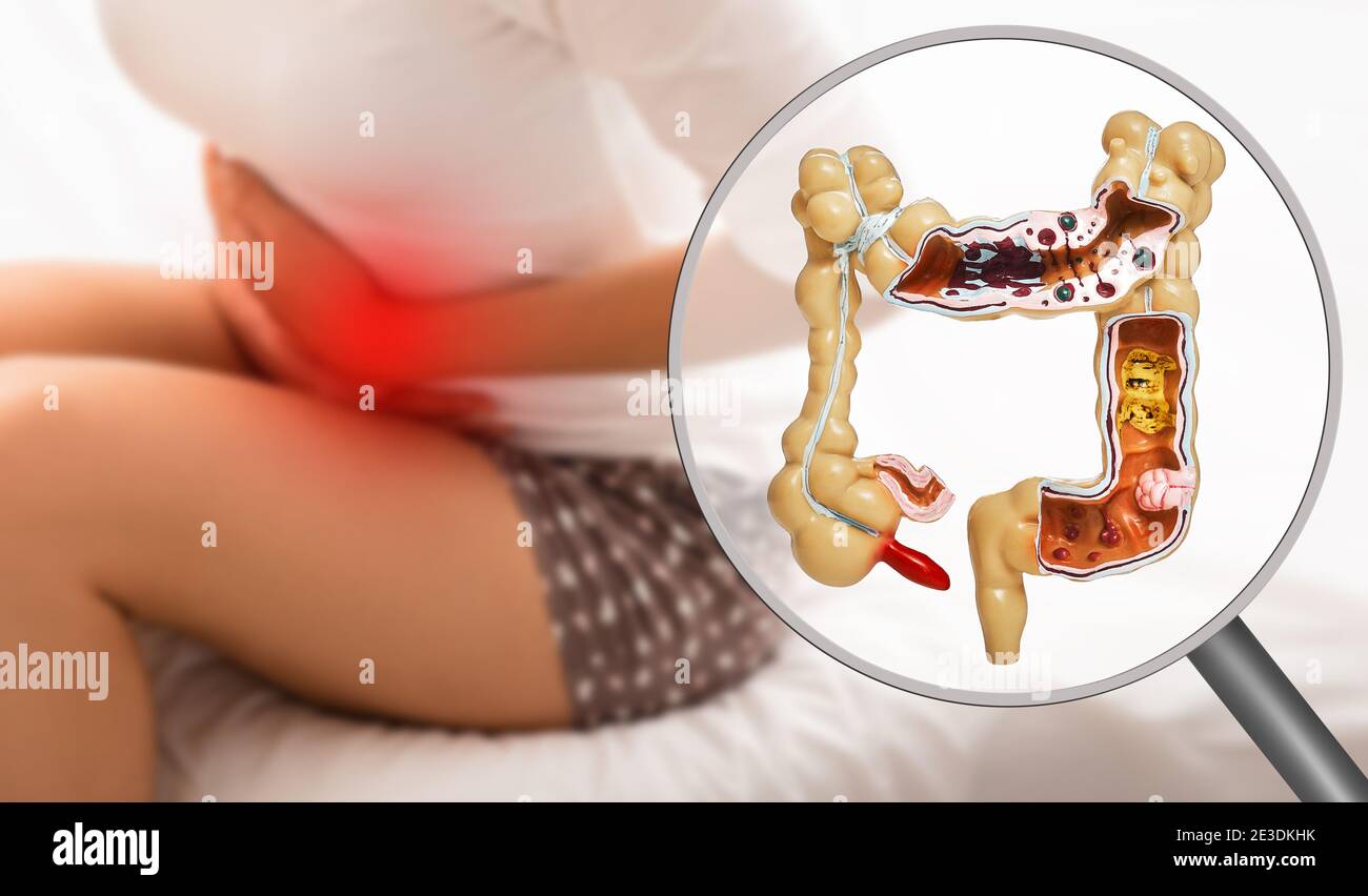 Pain in the intestines and abdomen. Dysbacteriosis, inflammation of intestines Stock Photo