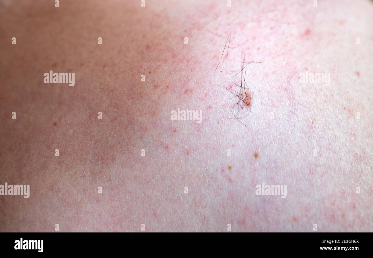 skin cancer risk from mole with hair growth Stock Photo - Alamy
