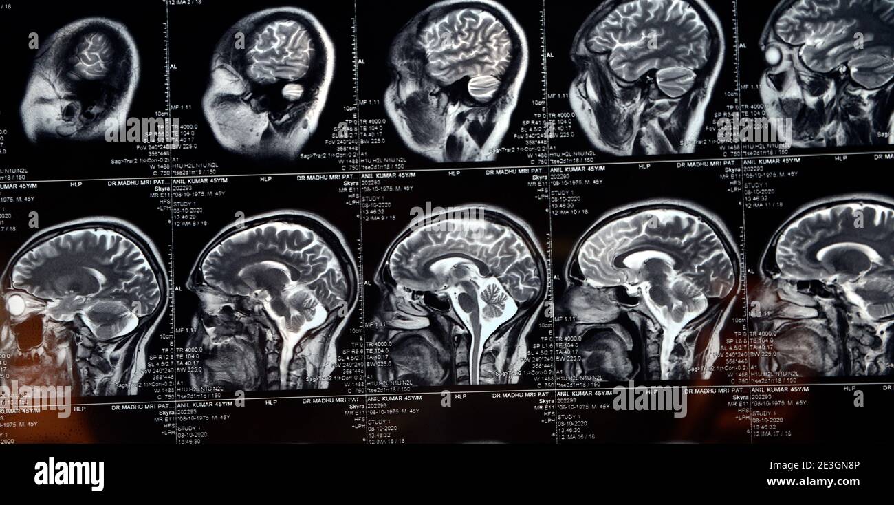 MRI Brain Scan of Head and Skull Stock Photo - Alamy