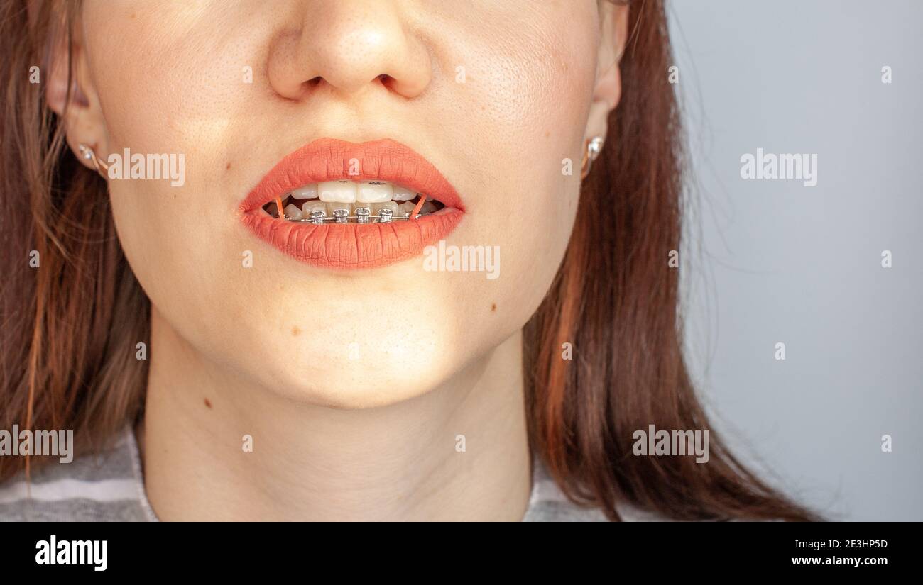 Braces in the smiling mouth of a girl. Closeup photos of teeth and