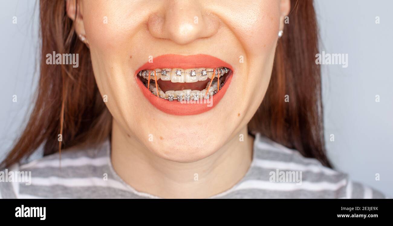 Braces in the smiling mouth of a girl. Closeup photos of teeth and