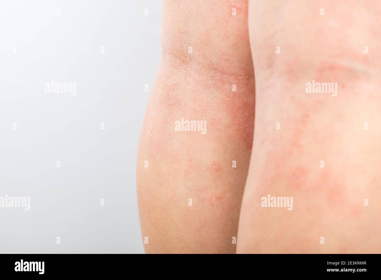 Acute atopic dermatitis on the legs behind the knees of a child is a dermatological disease of the skin. Large, red, inflamed, scaly rash on the legs Stock Photo