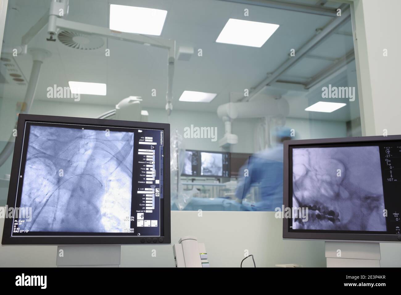 X-ray monitoring of neurosurgery on human brain in the hospital. Stock Photo