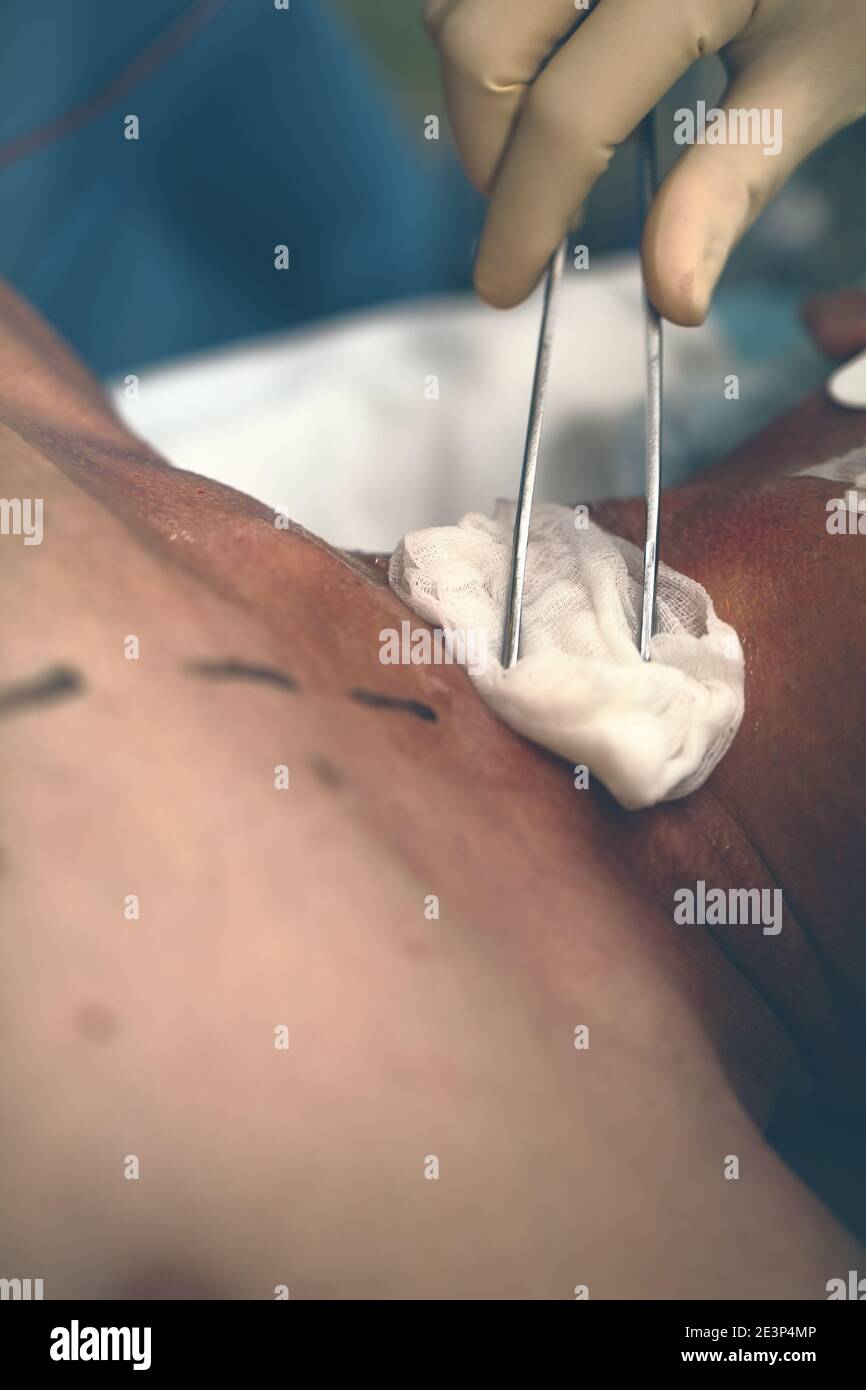 Medical nurse treats of male patient with gauze swab in disinfectant solution before the surgical operation. Stock Photo