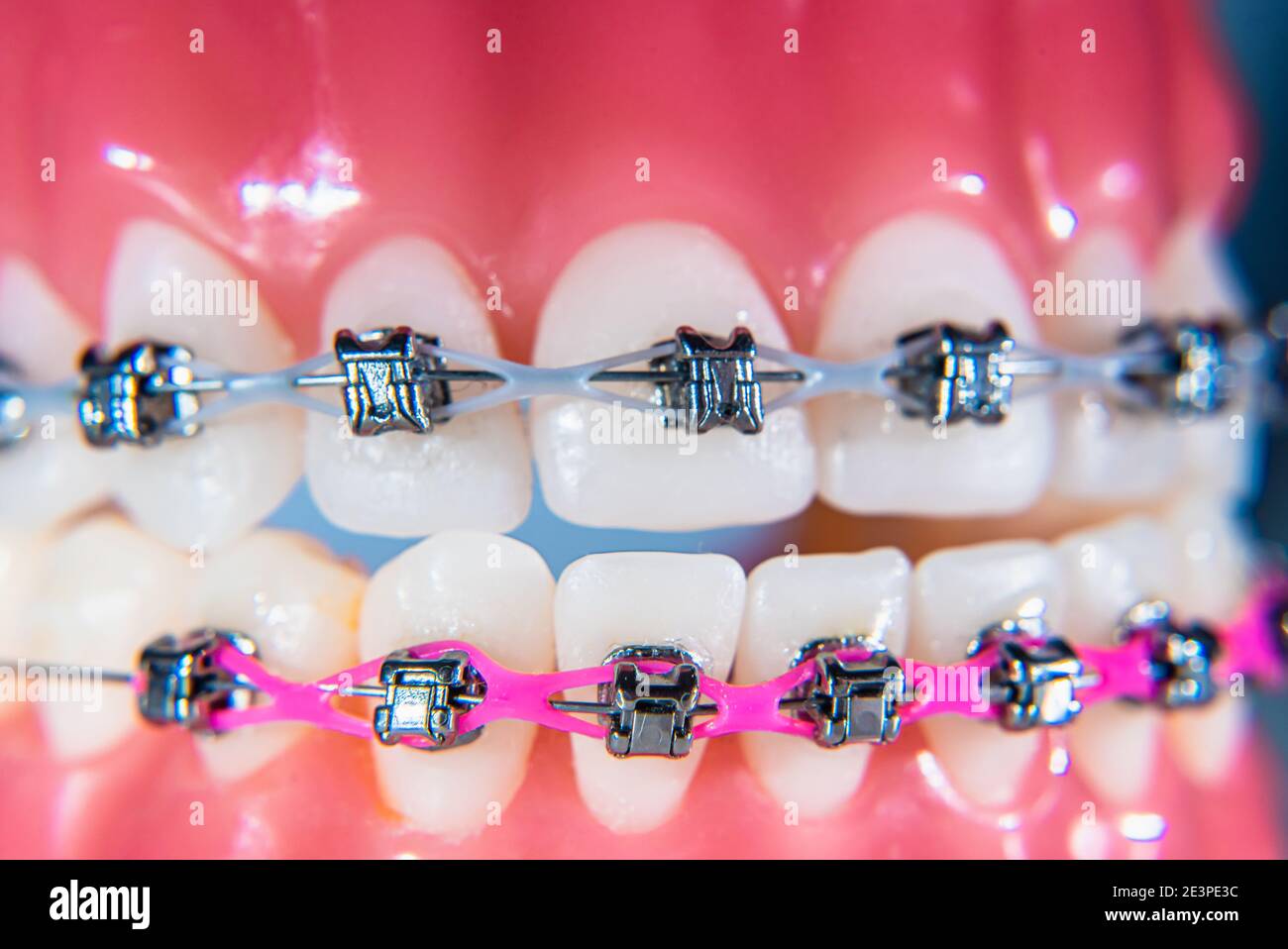 Teeth braces in the artificial jaw. Macro photography Stock Photo - Alamy