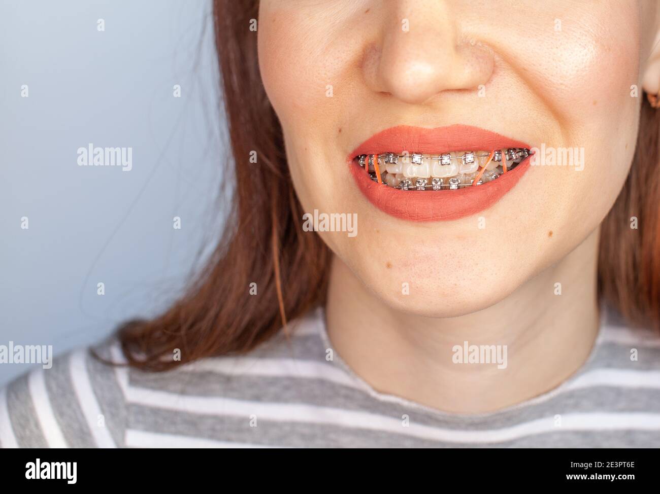 Braces in the smiling mouth of a girl. Closeup photos of teeth and