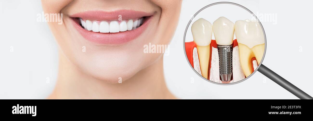 Perfect female smile, teeth after dental prosthetics by a dentist. Near magnified view of a dental implant installation Stock Photo