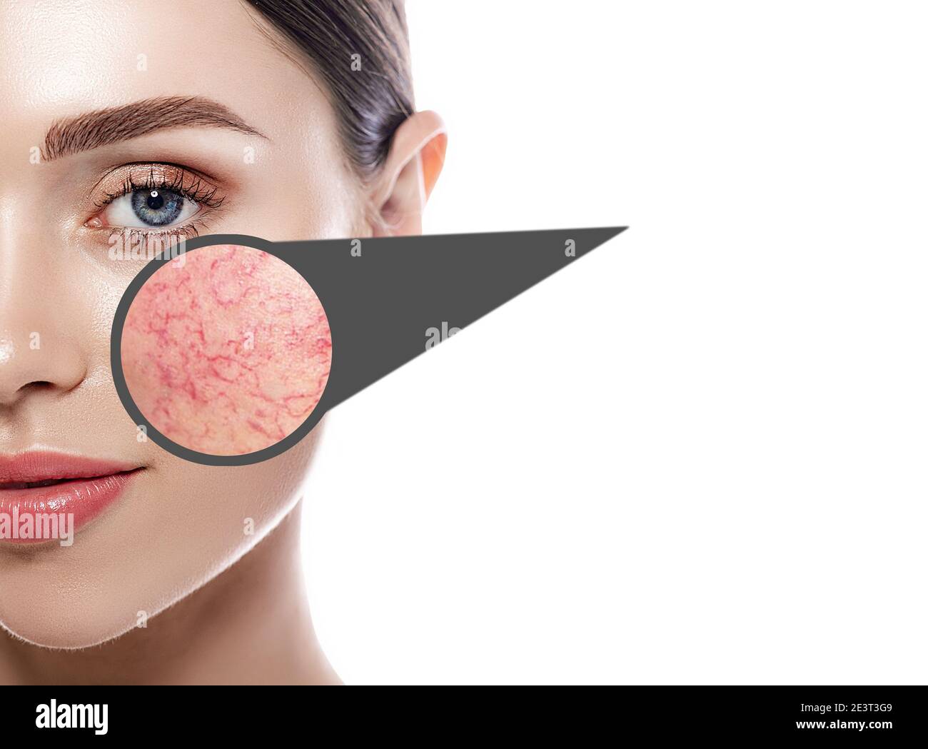 Magnifying glass showing couperose on face skin. Woman showing problems couperose-prone sensitive skin. Rosacea Stock Photo