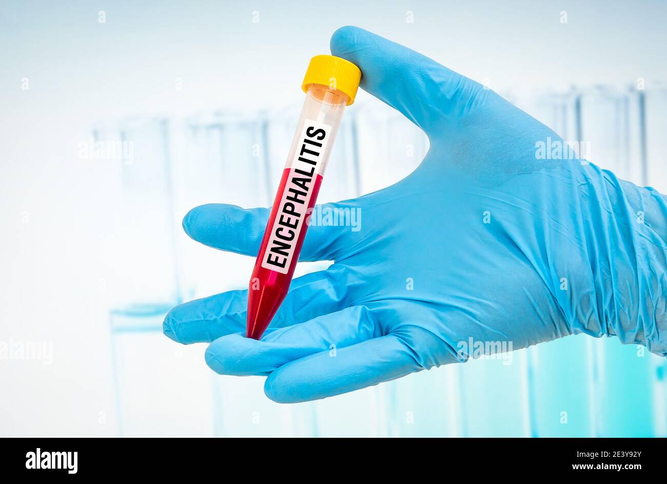 Scientists hand holding a test-tube with blood sample for ENCEPHALITIS ...