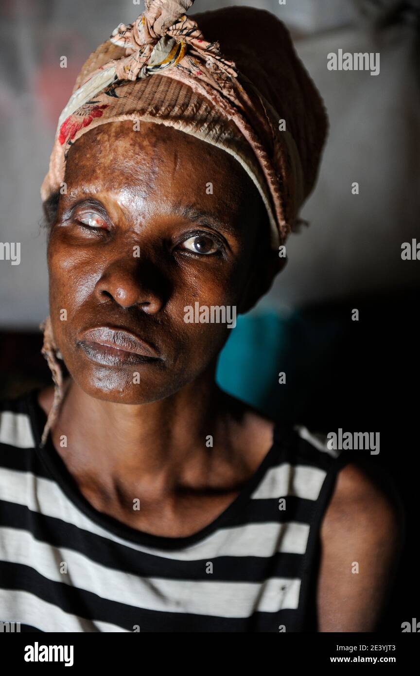 ZAMBIA, copperbelt, town Ndola, woman Anna Mulonga 47 years with HIV aids and skin infection / SAMBIA Ndola im Copperbelt, township Nkwazig, Anna Mulonga, sie ist an Aids HIV erkrankt und hatte eine Infektion, die Auge und Gesicht zerstoert haben Stock Photo