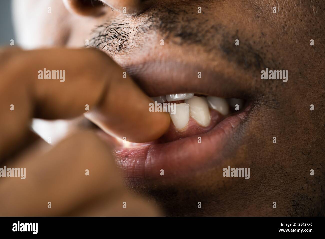 Neurotic Fingernail Biting Hands And Mouth Close Up Stock Photo