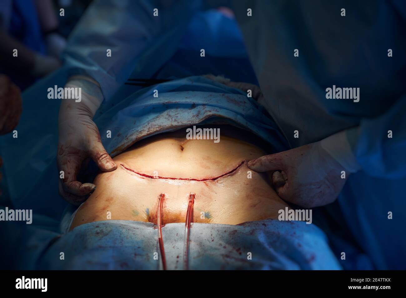 Medical stitches hi-res stock photography and images - Alamy