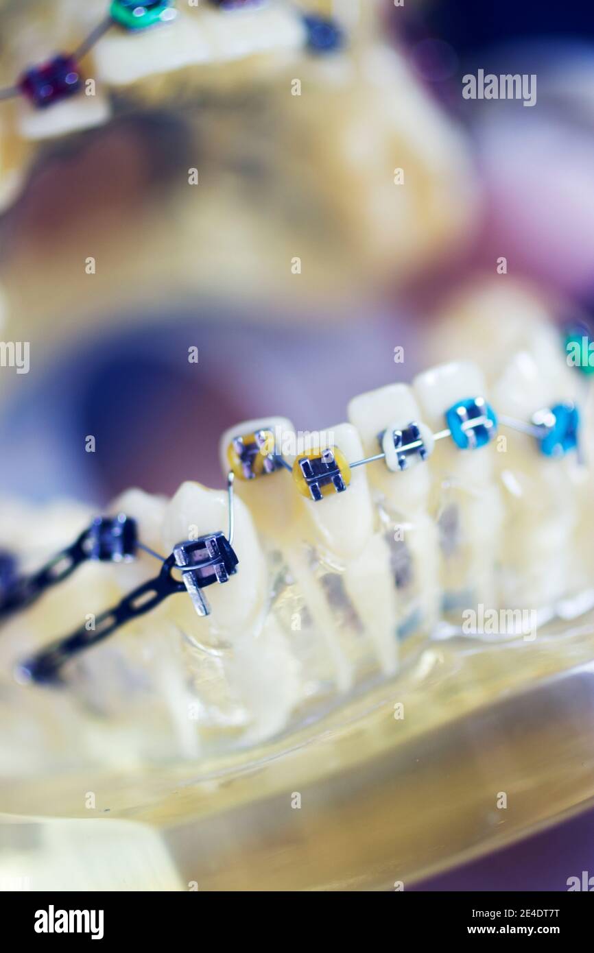 Dental teeth aligner bracket teaching student model showing gums and