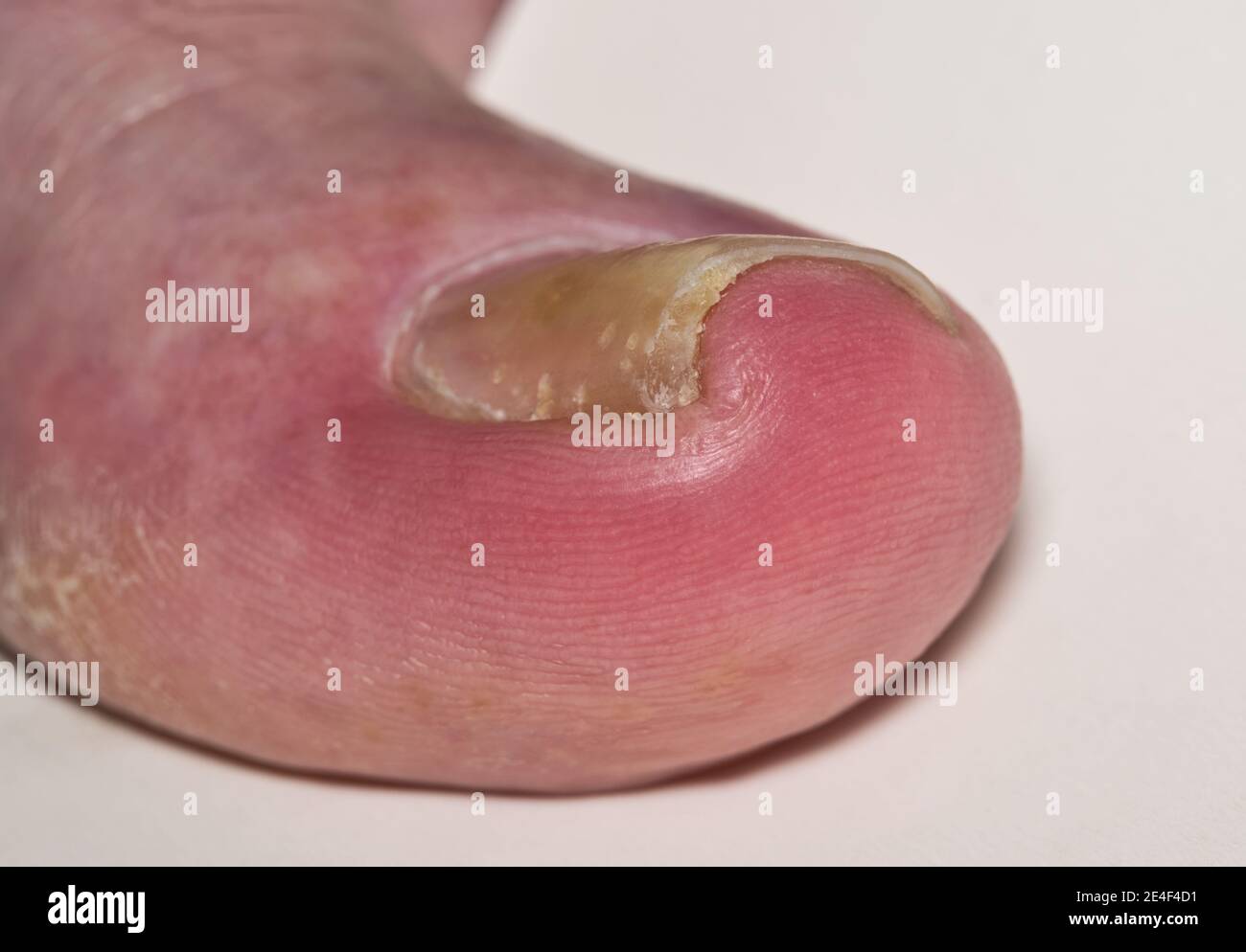 Ingrown toenail onychocryptosis on caucasian big toe Hallux, caused by