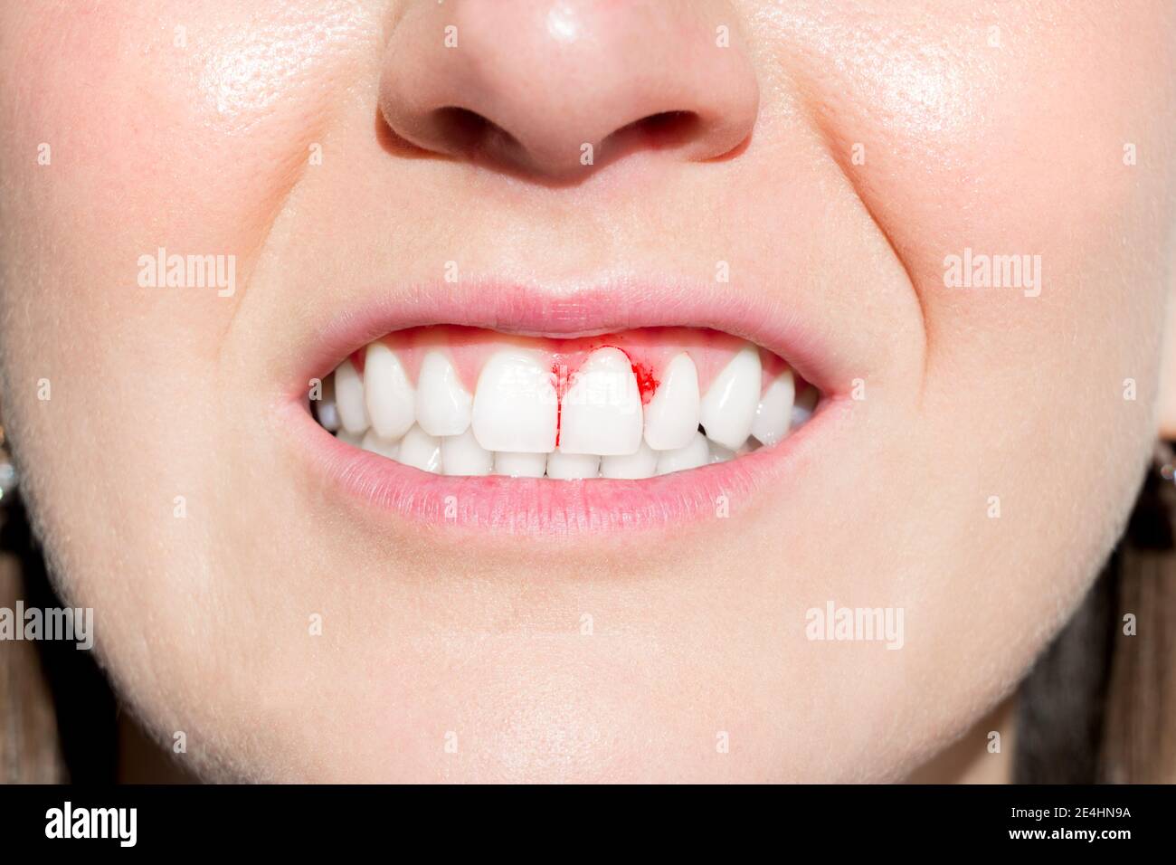 Scurvy mouth hires stock photography and images Alamy