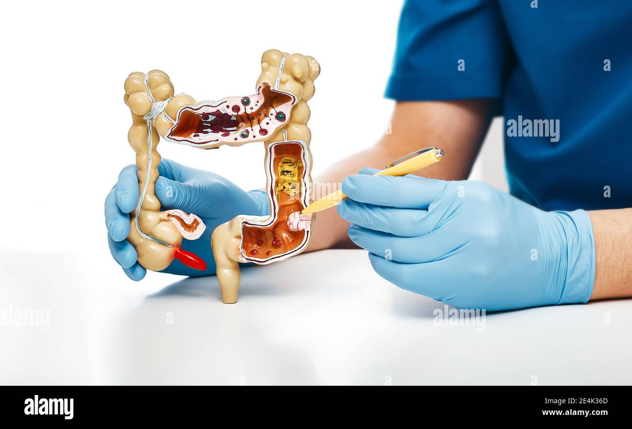 Cancer intestines. Gastroenterologist pointing pen tumor colon using an anatomical model for medical education Stock Photo