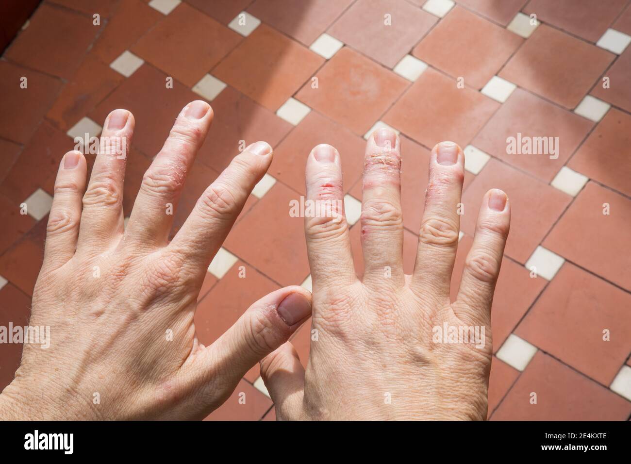 man showing his hands with eczema in skin fingers Stock Photo