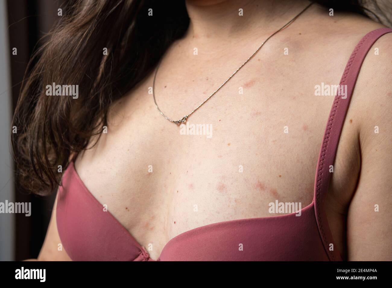Women with symptoms of itchy urticaria or allergic reaction on the skin.  Red rash on the females body. Concepts of allergy, skin diseases and health  c Stock Photo - Alamy