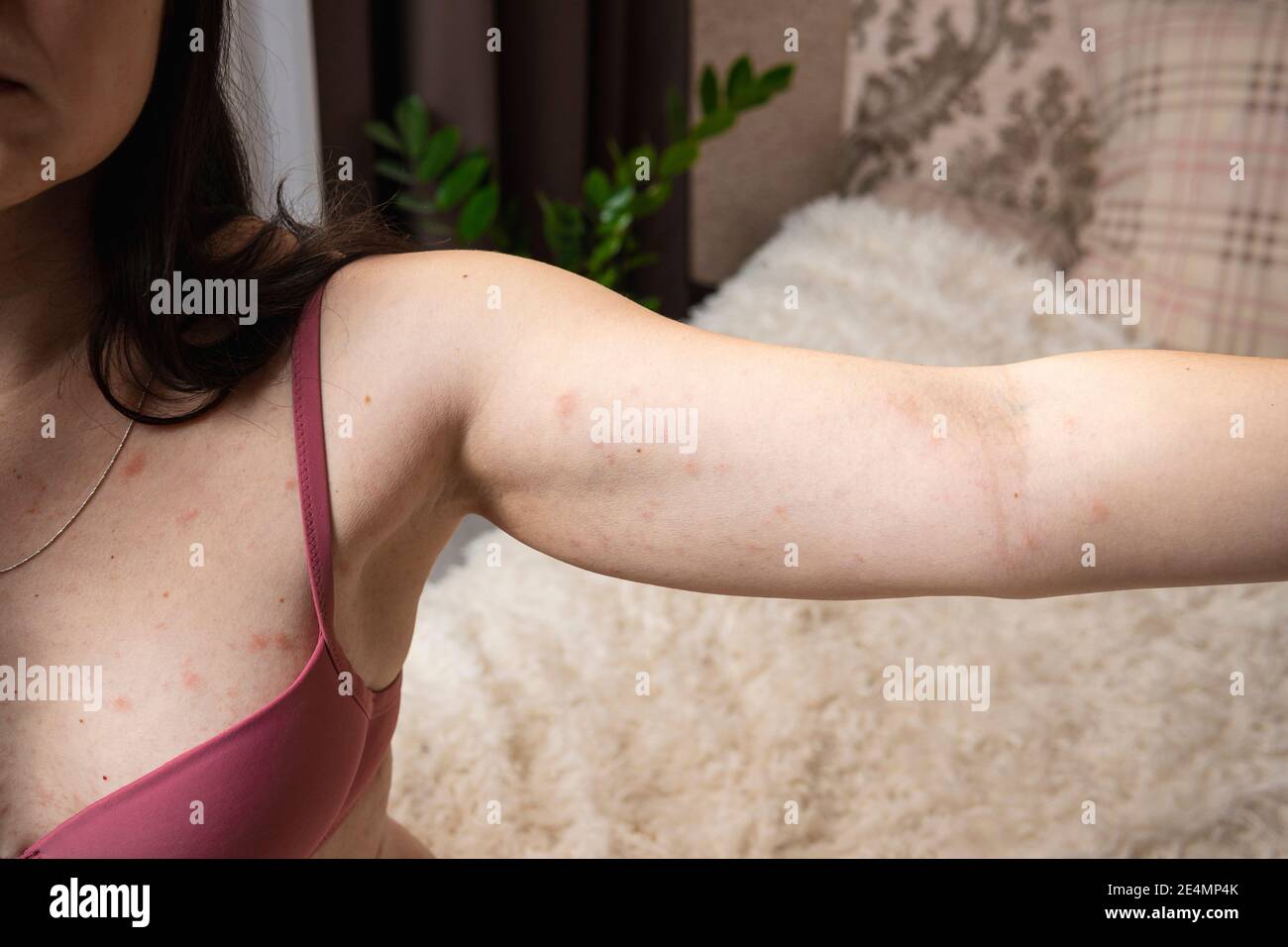Women with symptoms of itchy urticaria or allergic reaction on the skin ...