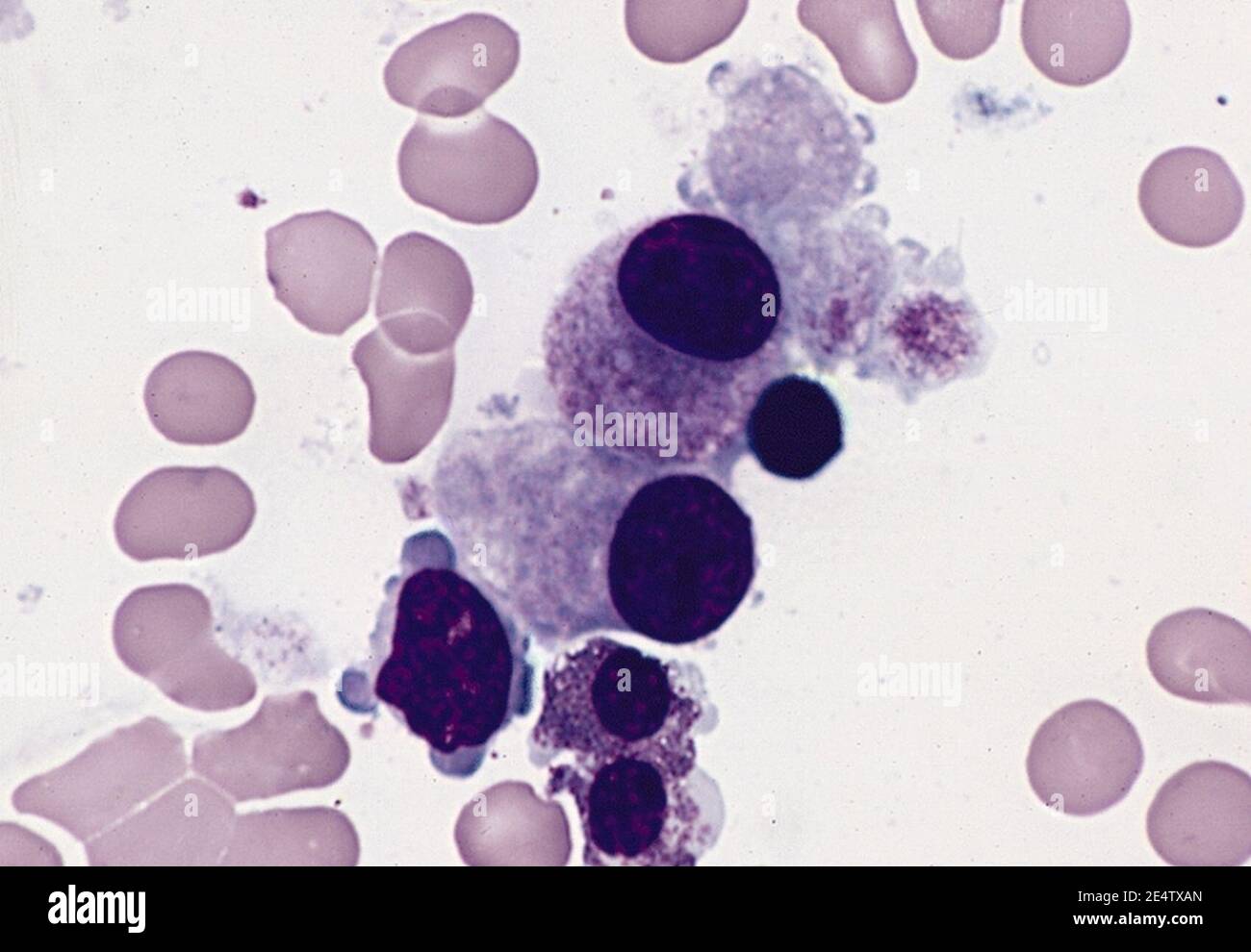 Megakaryocytes in MDS (RAEB and 5q-chromosome abnormality). Stock Photo