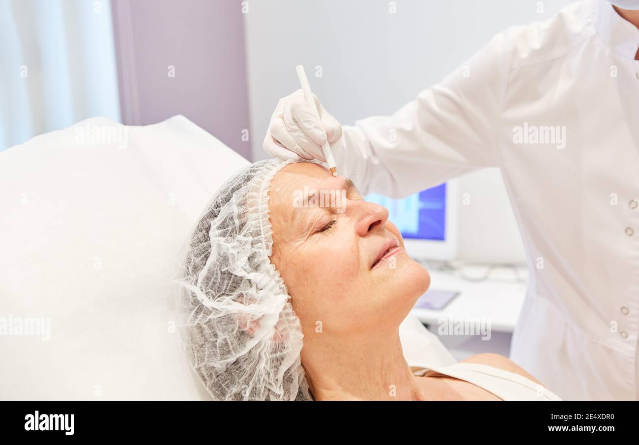 A patient's face is marked with hyaluronic acid dermal filler for the facelift Stock Photo