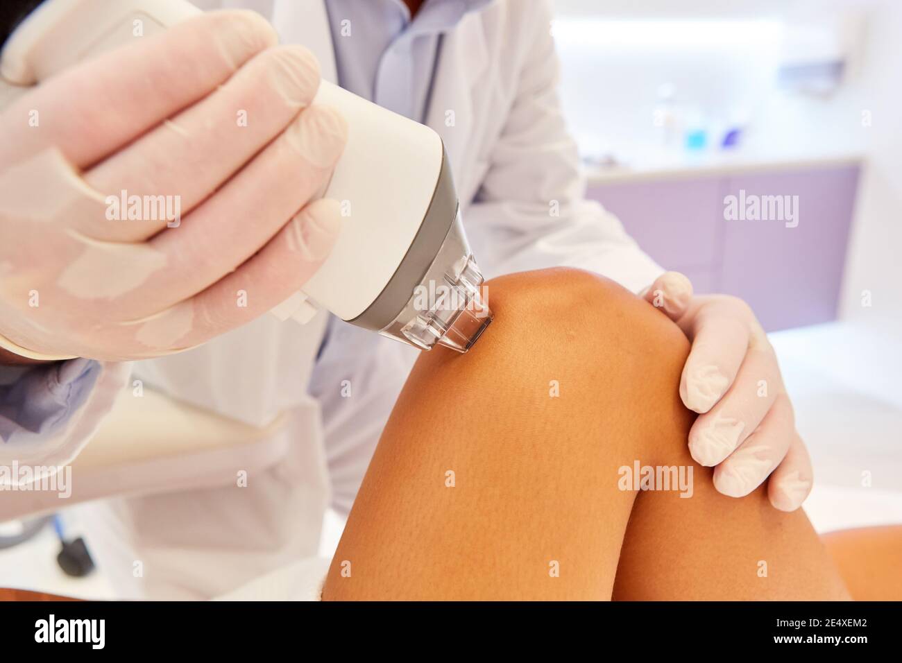 Skin tightening and rejuvenation on the thigh with Fraxel laser therapy Stock Photo