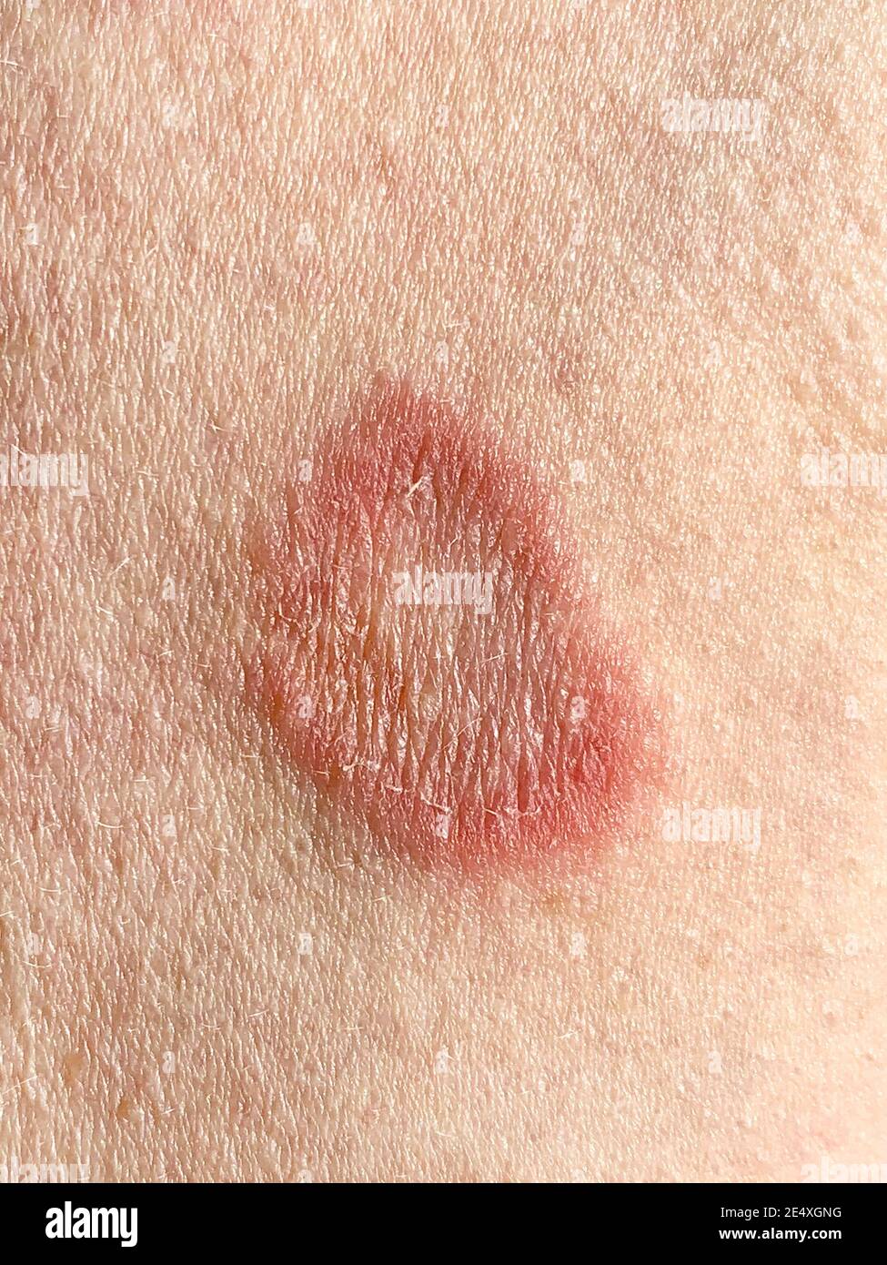 Ringworm infection on the arm of a caucasian adult male. This fungal skin infection causes itching, redness and scaly skin and the rings are called pl Stock Photo