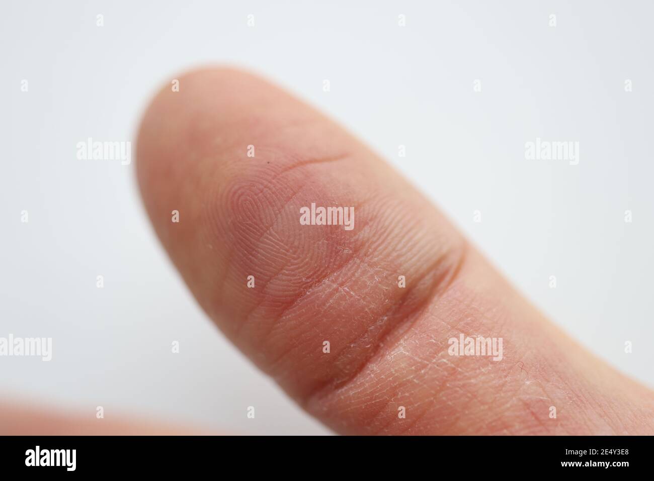 On finger there is red callus and an abscess Stock Photo Alamy