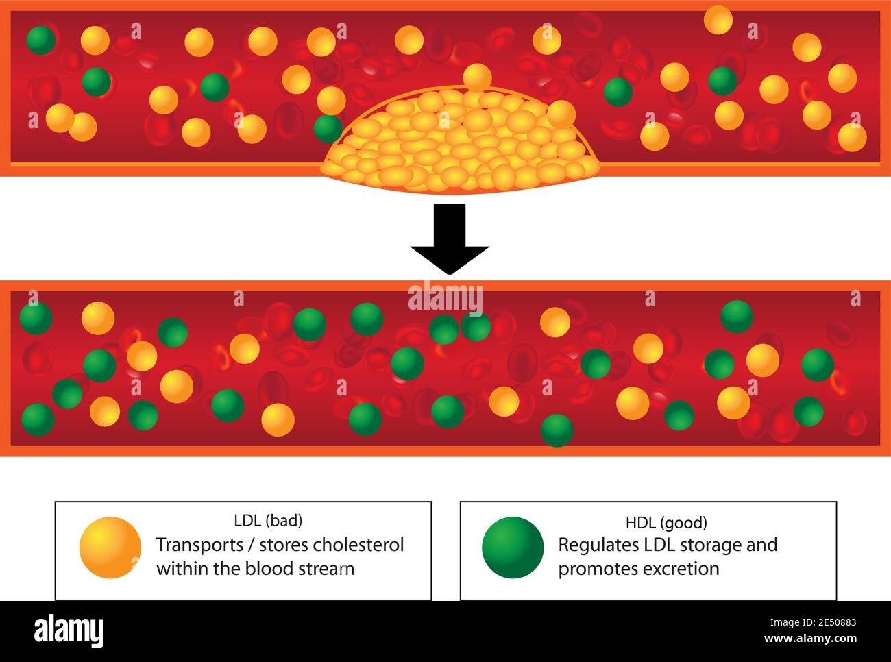 Role Of Good And Bad Lipids And Levels Of Atherosclerotic Plaque In Blood Vessel Stock Vector Image Art Alamy