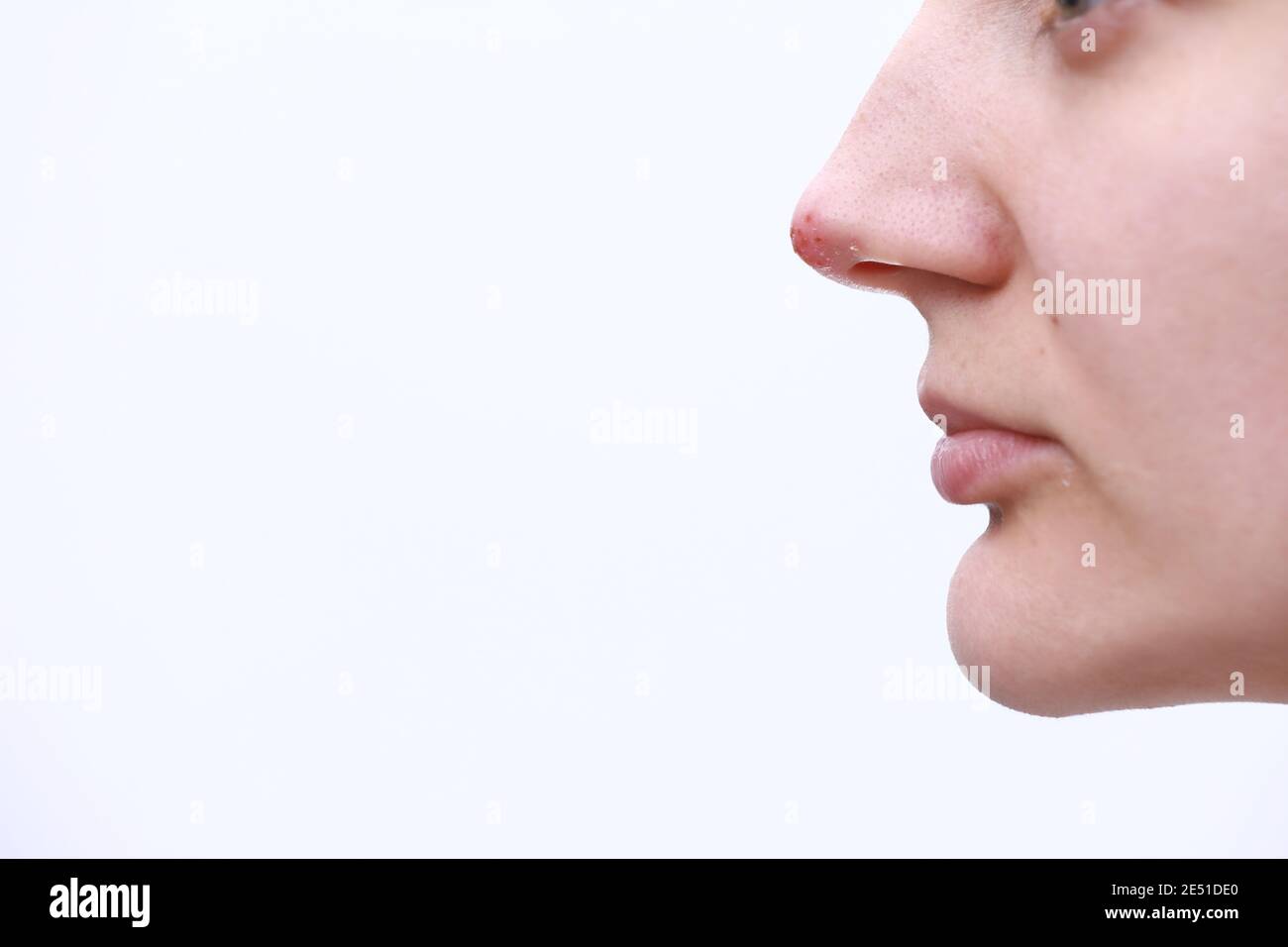 Herpes on the nose Pretty young woman with herpes her on nose. Human