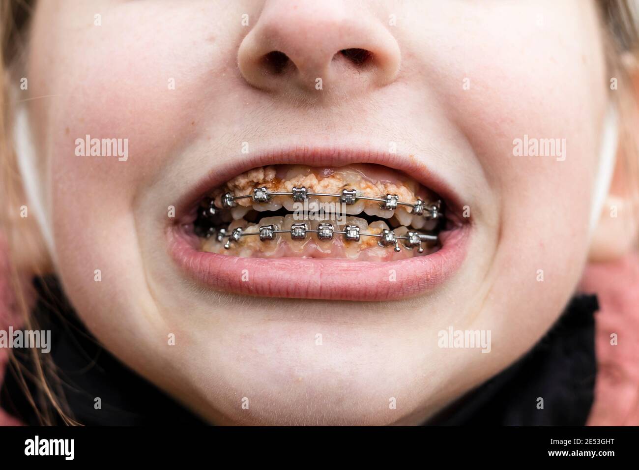Dirty braces after eating food without cleaning. Closeup of blonde