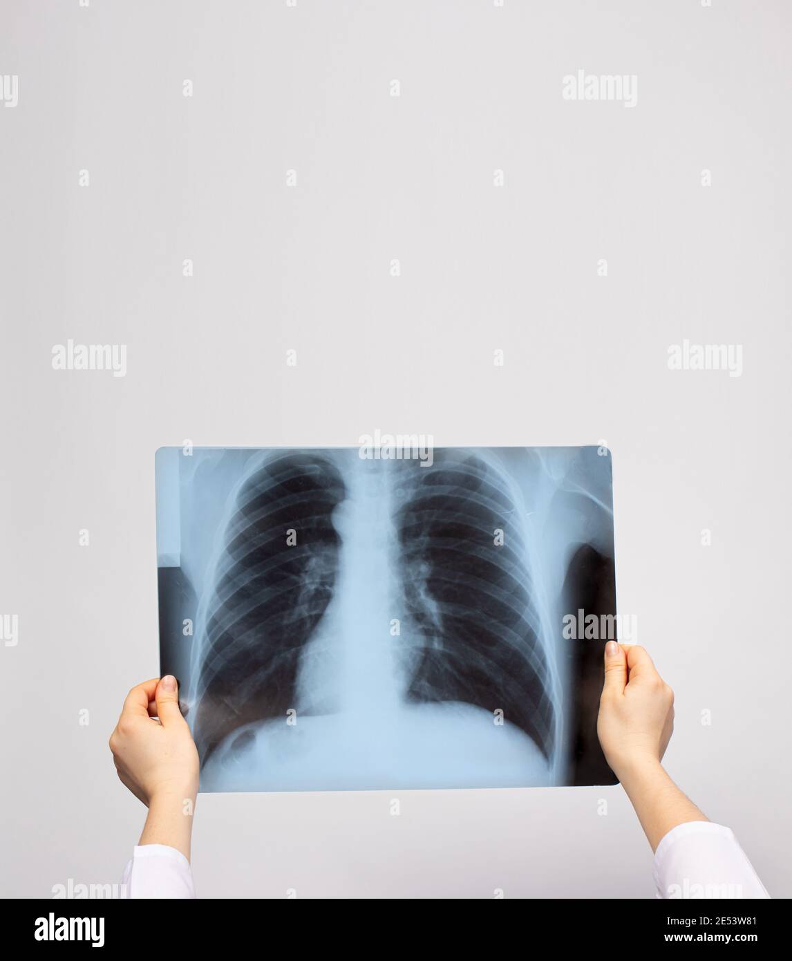 A doctor examines an Xray of the lungs of a patient with pneumonia