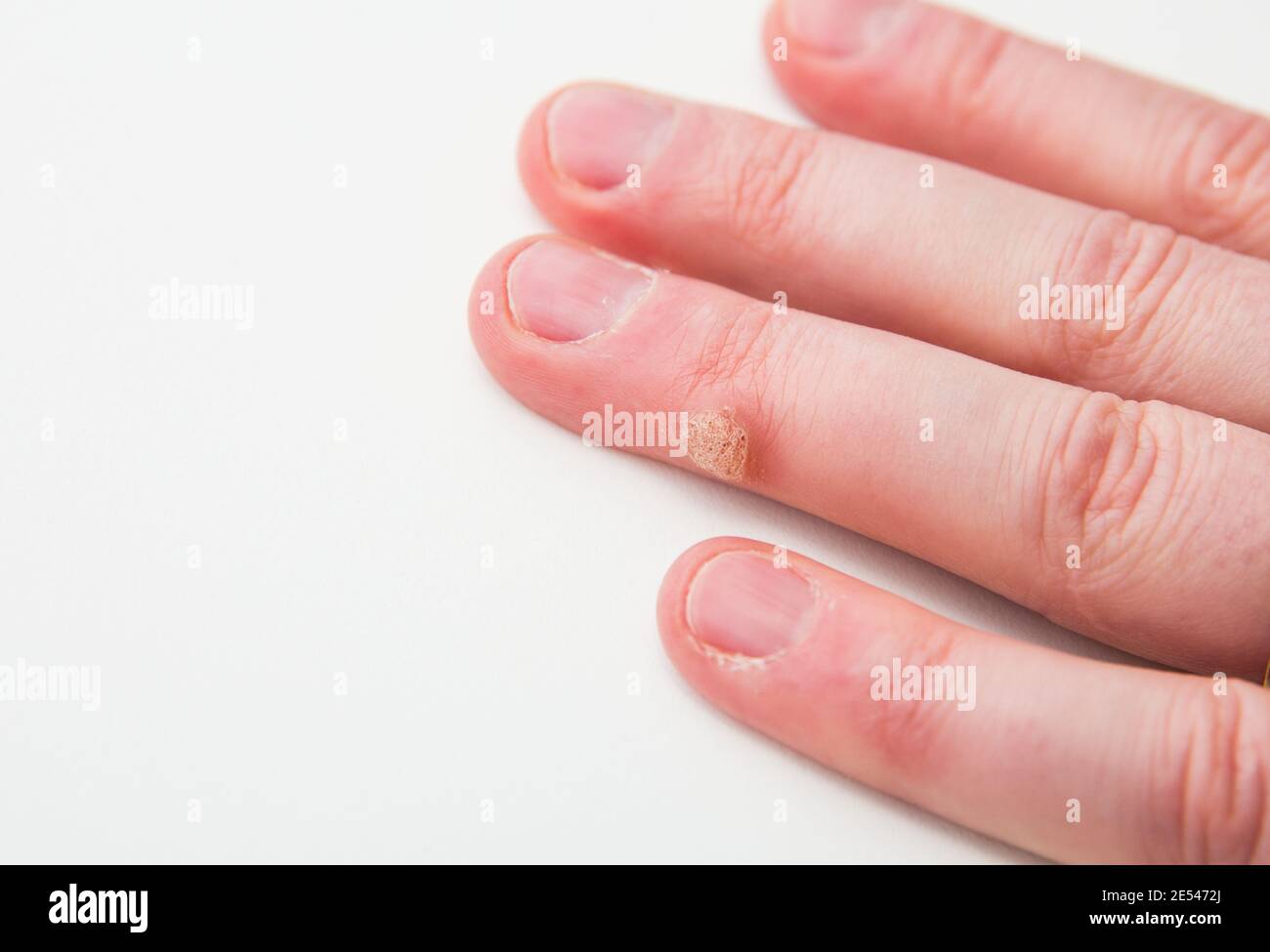 Close up view of skin disease called wart caused by human papilloma virus on human finger. Stock Photo