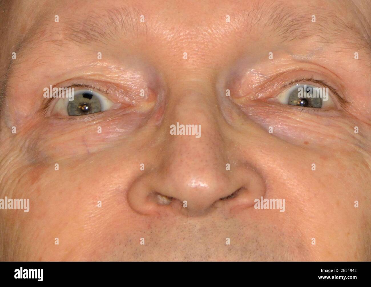 Therapeutic corneal tattoos to reduce dysphotopsia and glare following  Laser Peripheral Iridotomies which prevent acute primary angle closure  Stock Photo - Alamy