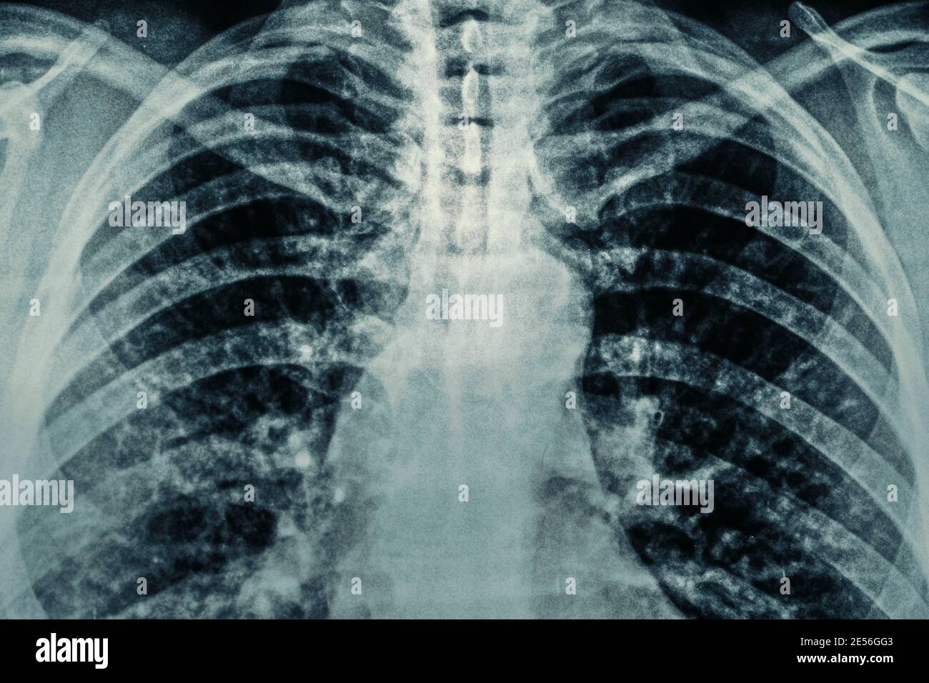 Macro photo of Radiological chest xray film with film grain. Asthma